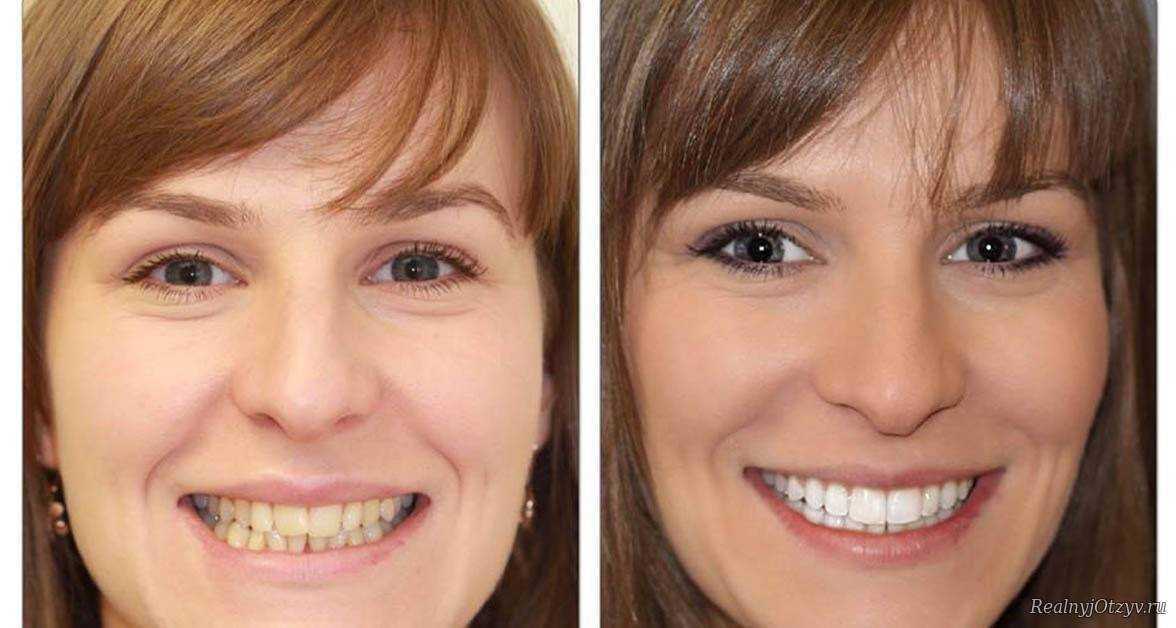 Изменение формы зубов. Хорошие зубы. Зубы с винирами до и после.