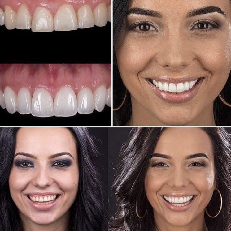 Изменение формы зубов